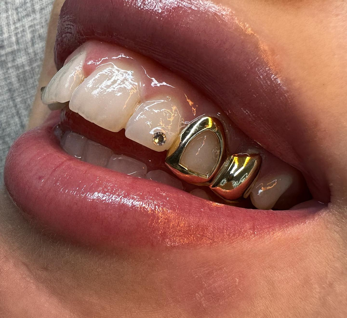 Close-up of a client's smile showing custom gold grillz and a sparkling tooth gem