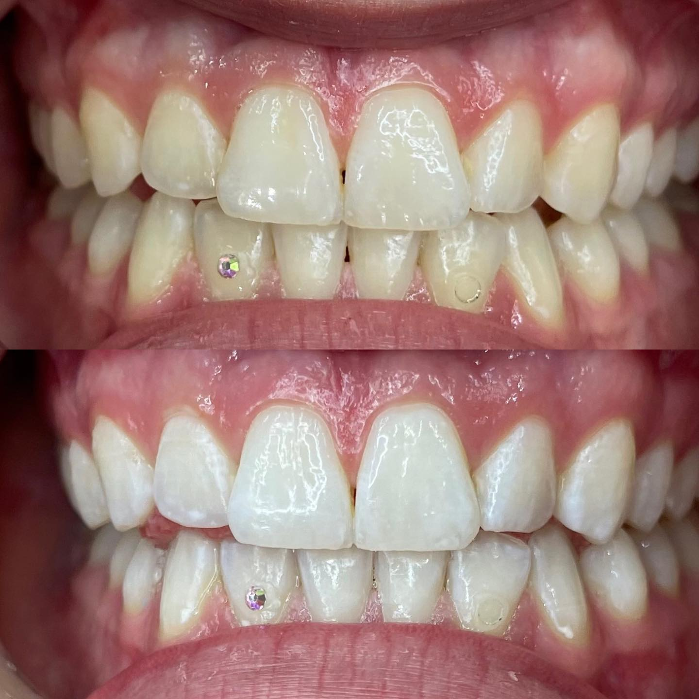 In-studio teeth whitening result S8 Active Light