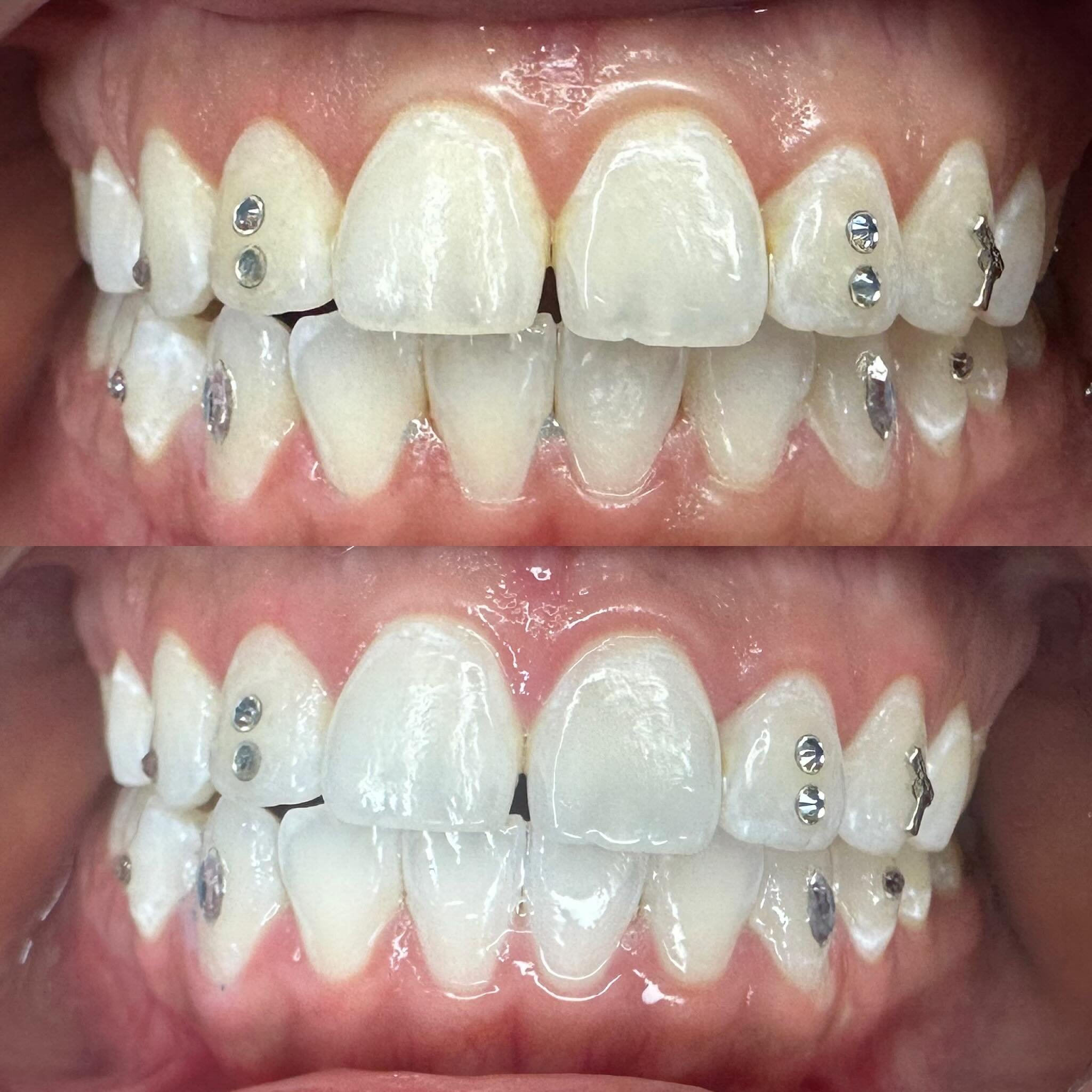 In-studio teeth whitening result S2 Elite Glow