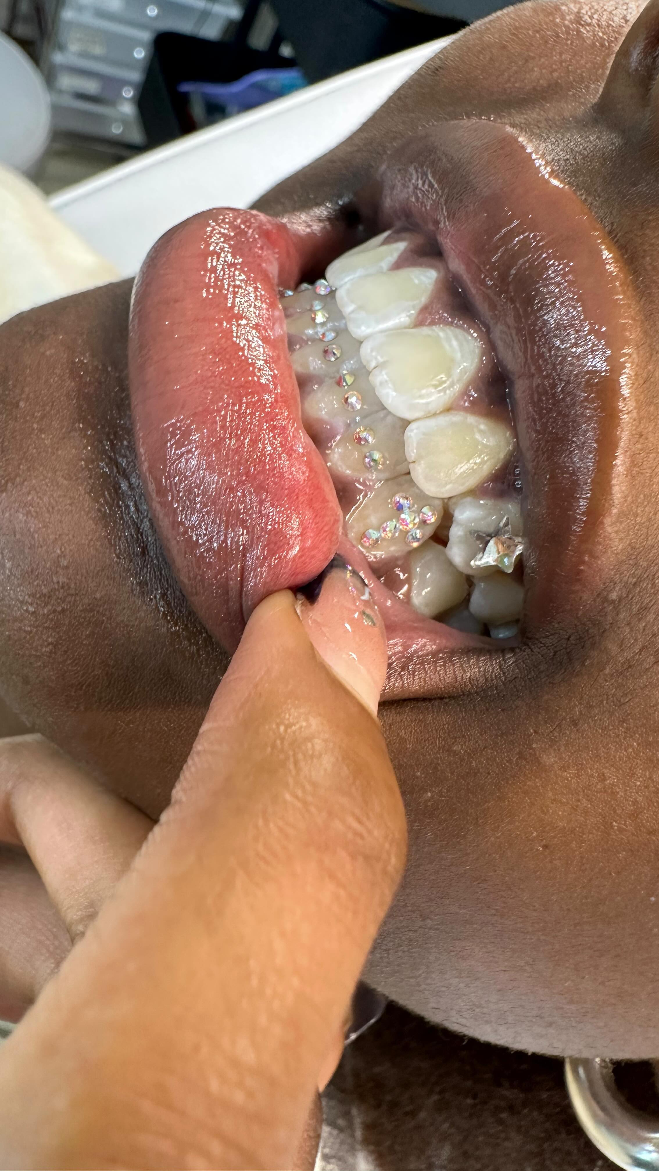Client showing white tooth gems