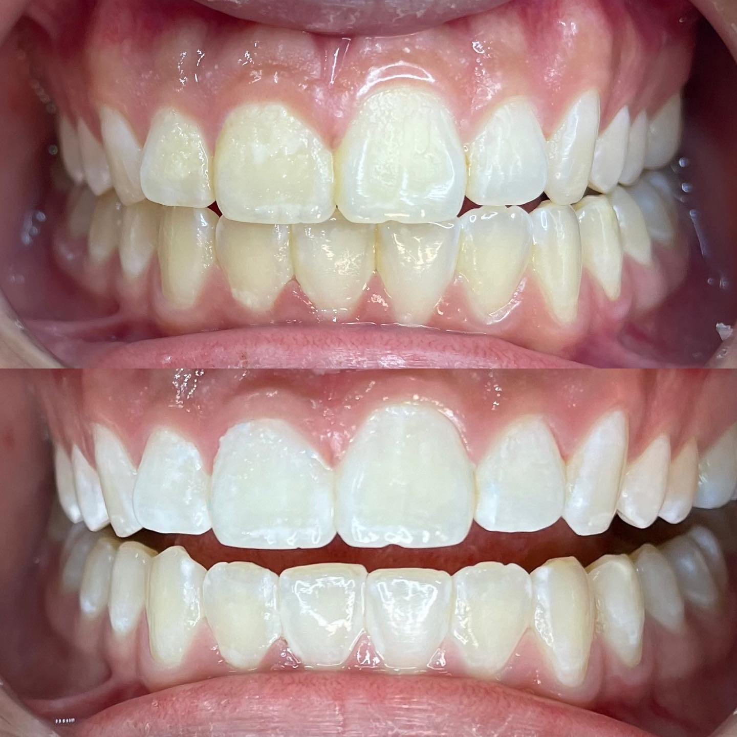 In-studio teeth whitening result S4 Fresh Shine