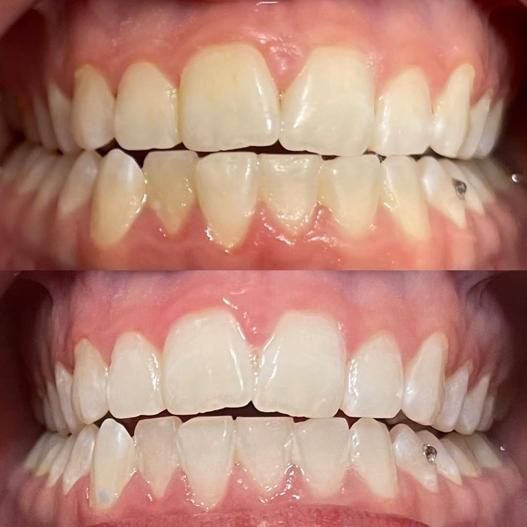 In-studio teeth whitening result S6 Glow Up