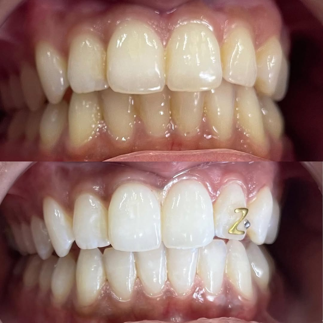 In-studio teeth whitening result S10 Prep Kit